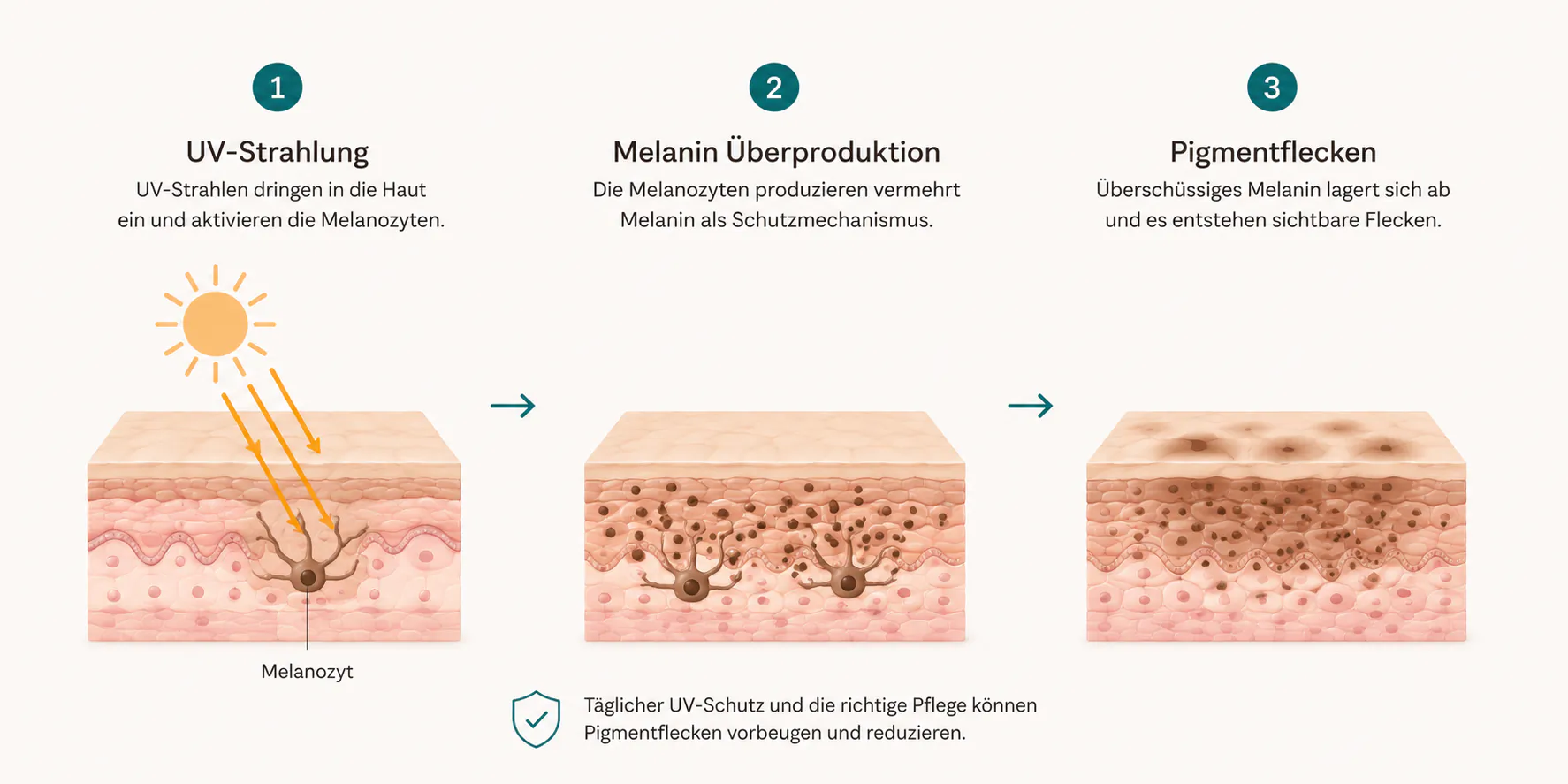Grafik UV-Strahlung Melanin Pigmentflecken